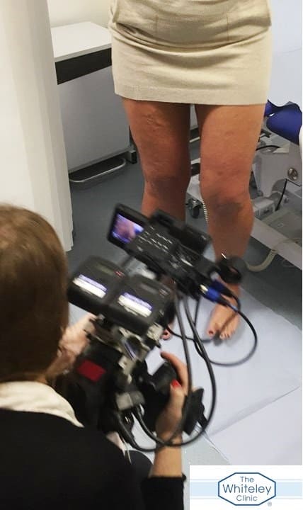 Varicose veins on TV - Filming varicose veins consultation at The Whiteley Clinic London - 16 Jan 2017