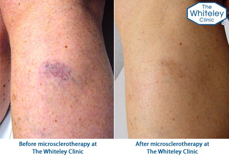 Before and after Microsclerotherapy treatment for thread veins - telangectasia spider veins CEAP-C1