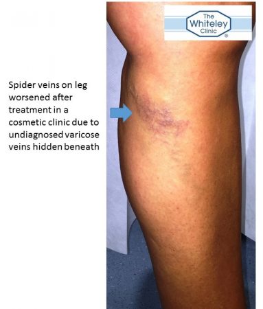 Leg spider veins worse after treatment due to hidden varicose veins