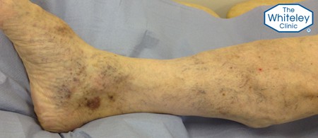 Venous skin damage at the ankle - CEAP-C4