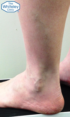 Varicose Veins of the outer lower leg and lateral ankle - CEAP C2