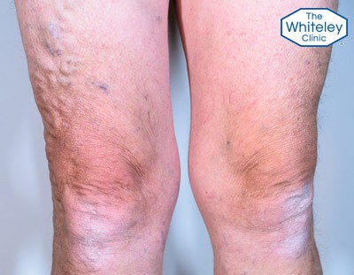 Varicose veins of the legs