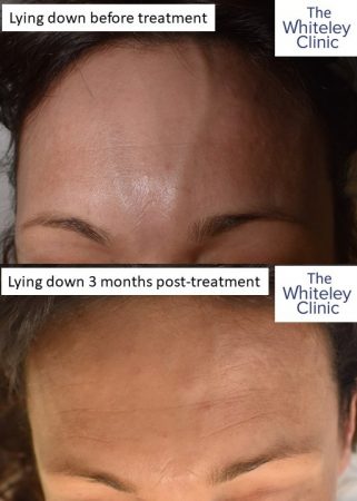 Forehead veins removed at The Whiteley Clinic
