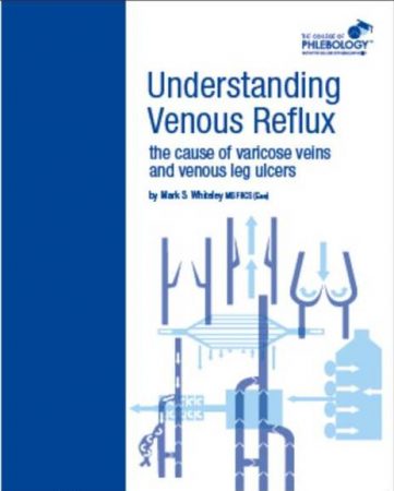 Understanding venous reflux the cause of varicose veins and venous leg ulcers by Mark S Whiteley