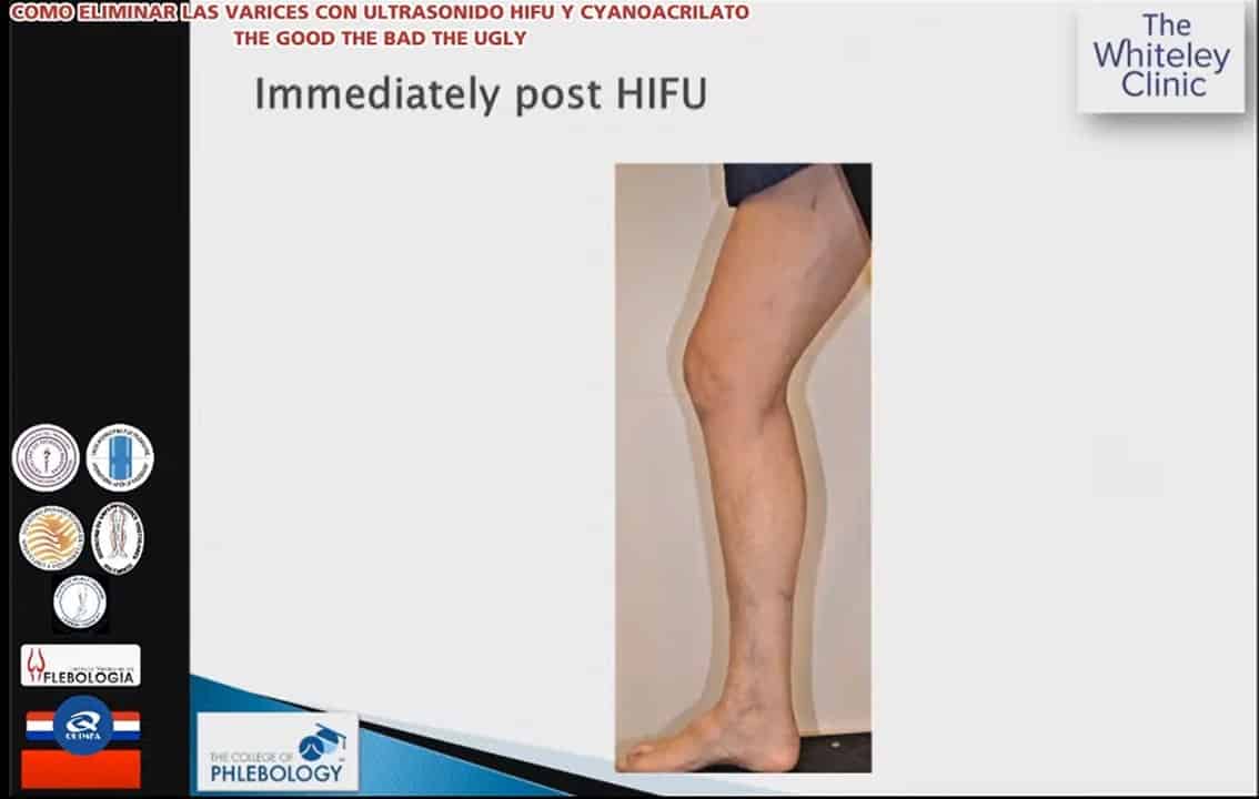 Immediately after varicose veins surgery using HIFU Treatment of Varicose Veins &ndash; Webinar 13 August 2020