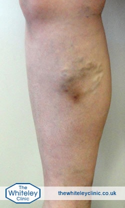 Phlebitis in a lower leg