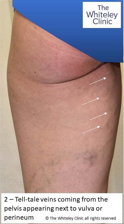 Tell-tale varicose vein arising from pelvis and emerging by vulva or perineum on inner thigh PCS