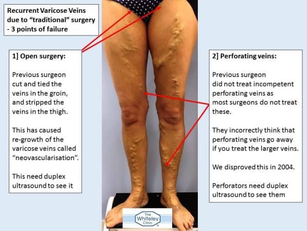 Bilateral recurrent varicose veins - 3 missed sources of varicose veins - came to The Whiteley Clinic for help - 1 and 2