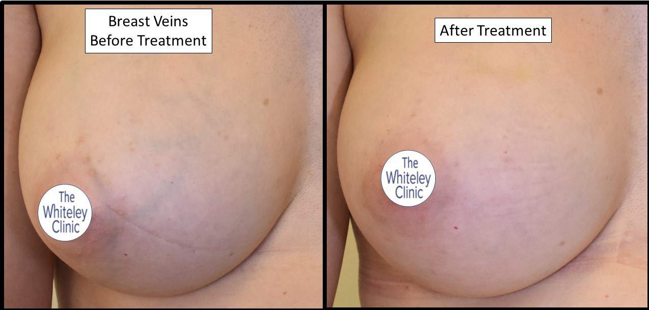 Breast vein removal - before and after at The Whiteley Clinic Pioneering Vein Treatments