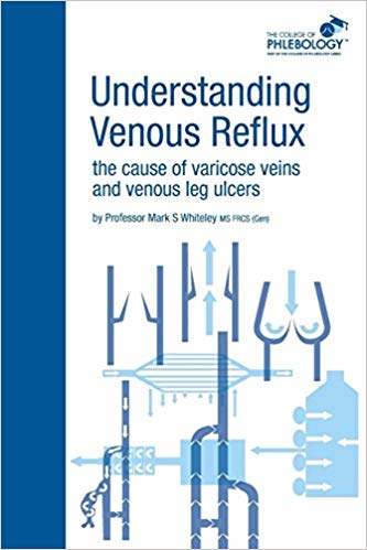 Understanding Venous Reflux