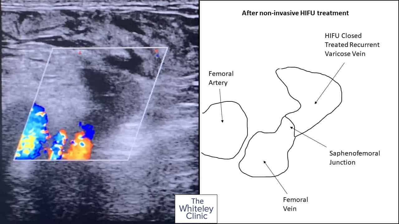 HIFU treatment of recurrent varicose veins &ndash; after non-invasive treament the stump is completely closed