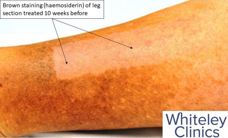 Brown stains on legs - haemosiderin - new combination treatment at The Whiteley Clinic - Available Jan 2019