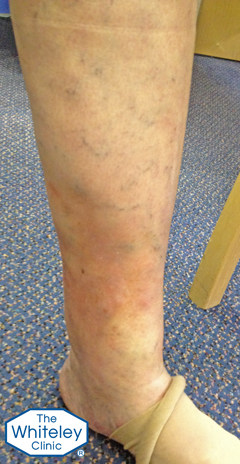lipodermatosclerosis LDS - secondary to varicose veins skin damage - CEAP-C4