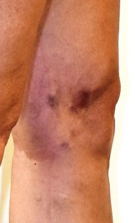 Spider veins or left leg and matting resistant to treatment - Should have had a duplex scan as she has underlying hidden varicose veins