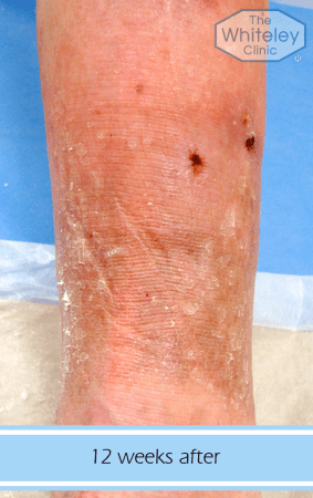 Permanent cure for leg ulcers after venous surgery at The Whiteley Clinic