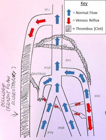 Duplex ultrasound at The Whiteley Clinic shows how the foam sclerotherapy has failed to treat the underlying reflux