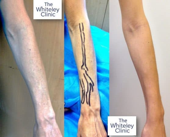 Left arm veins removal at The Whiteley Clinic
