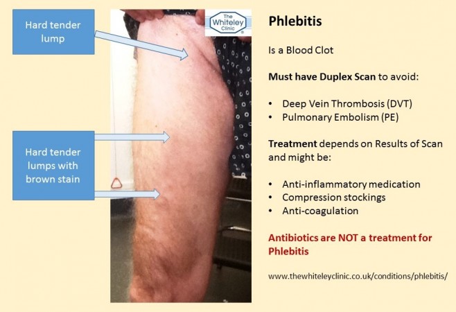 Having a Duplex Scan may save your life - Treatment for Phlebitis is not antibiotics