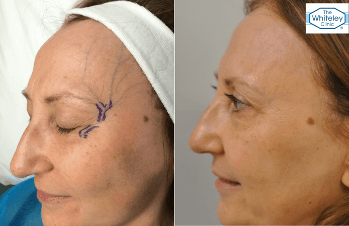 Facial temple veins, facial veins, testimonial, veins, vein health, cosmetic