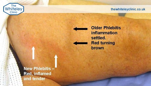 Diagram showing old and new phlebitis