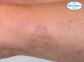 Typical thread veins on thigh - Telangectasia spider veins - CEAP-C1