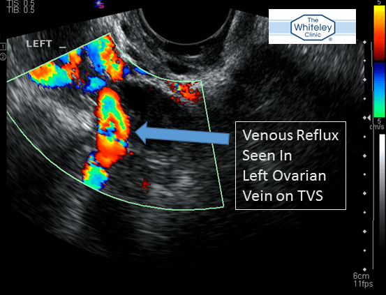 Ovarian vein reflux seen on Transvaginal Duplex Scanning - the best test for Pelvic Varicose Veins and part of The Whiteley Protocol for pelvic varicose veins