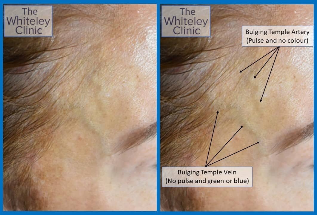 Bulging temple artery and bulging temple vein before treatment at The Whiteley Clinic