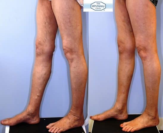 Recurrent varicose veins both after stripping 10 years ago - treated successfully by The Whiteley Protocol - Left