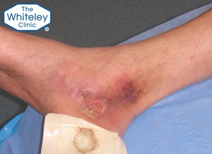 Venous leg ulcer curable by endovenous surgery using The Whiteley Protocol