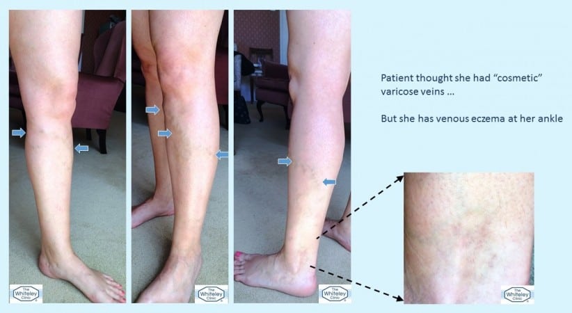 Cosemtic varicose veins actually causing venous eczema - varicose eczema - diagnosed at The Whiteley Clinic