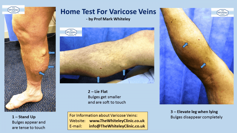 Home Test For Varicose Veins - A Simple Test For Visible Varicose Veins By Mark Whiteley of The Whiteley Clinic