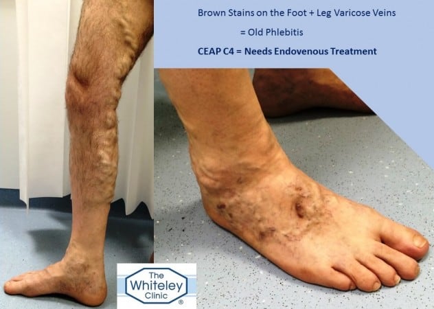 Brown Stains on Feet from Superficial Thrombophlebitis - Phlebitis - CEAP C4 - Diagnosed and Cured at The Whiteley Clinic