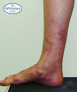 Venous Eczema