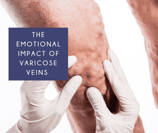 The Emotional Impact of Varicose Veins