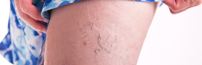 thread veins on legs - patient pathway