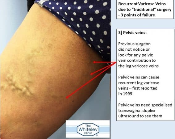 Bilateral recurrent varicose veins - 3 missed sources of varicose veins - came to The Whiteley Clinic for help - 3