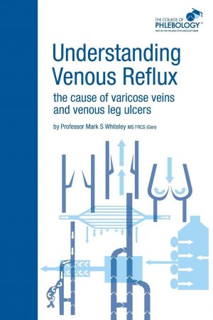 Understanding Venous Reflux - The Cause of Varicose Veins and Venous Leg Ulcers