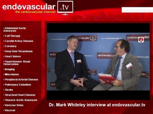 Mark Whiteley interviewed about new treatments for varicose veins on Endovascular TV in October 2014