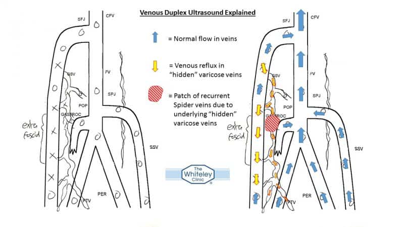 Venous Duplex Ultrasound showing varicose veins underlying - spider veins thread veins - The Whiteley Clinic