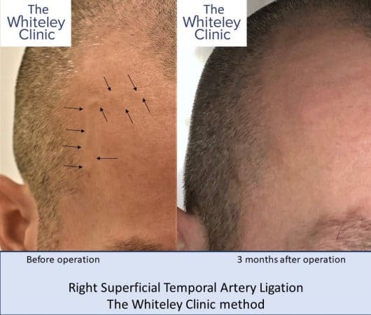 Right Superficial Temporal Artery Ligation using Whiteley Clinic technique