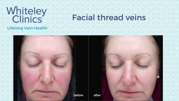 Before and after photos showing successful treatment of cheek thread veins