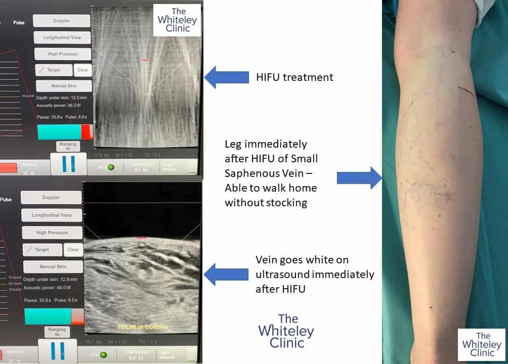 Treatment of small saphenous vein with HIFU &ndash; patient able to walk home immediately without stocking