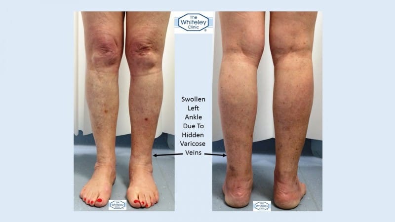 Swollen left ankle due to hidden varicose veins missed for 10 Years