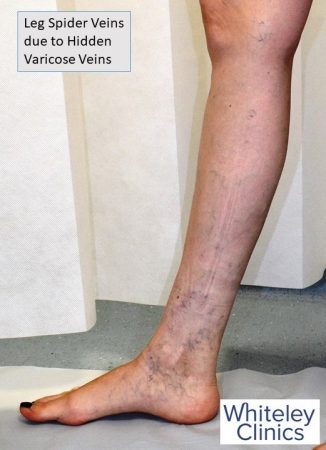Leg spider veins due to hidden varicose veins - found by Whiteley Protocol