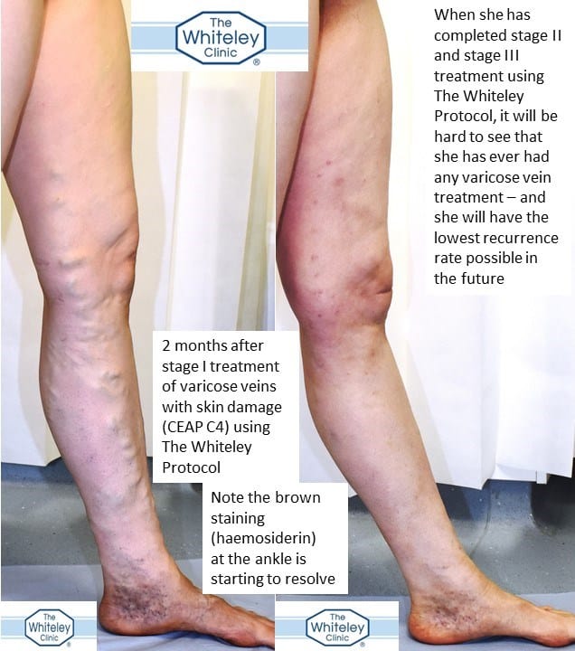 Before and after varicose veins with brown stains skin damage - haemosiderin - CEAP C4