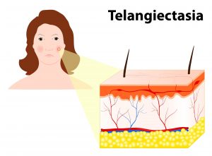 Diagram of Telangiectasia