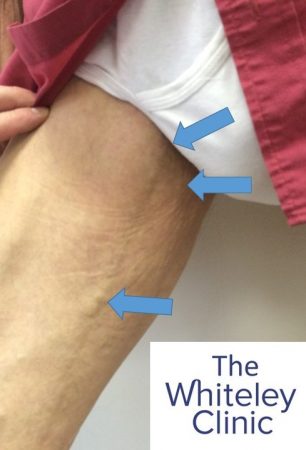 Varicose veins in a man arising from pelvic varicose veins &ndash; The Whiteley Clinic
