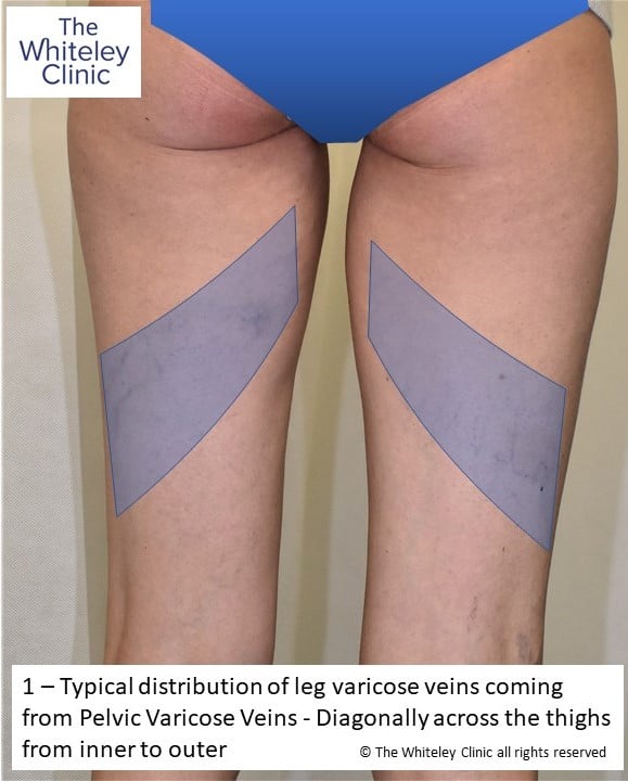 Typical distribution of varicose veins arising from pelvic varicose veins PCS