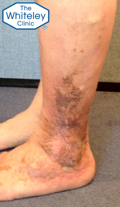 Lateral venous leg ulcer outside of ankle cured by The Whiteley Protocol - CEAP-C5