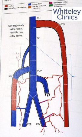 Duplex ultrasound report showing hidden varicose veins - red - causing spider veins on surface - The Whiteley Clinic